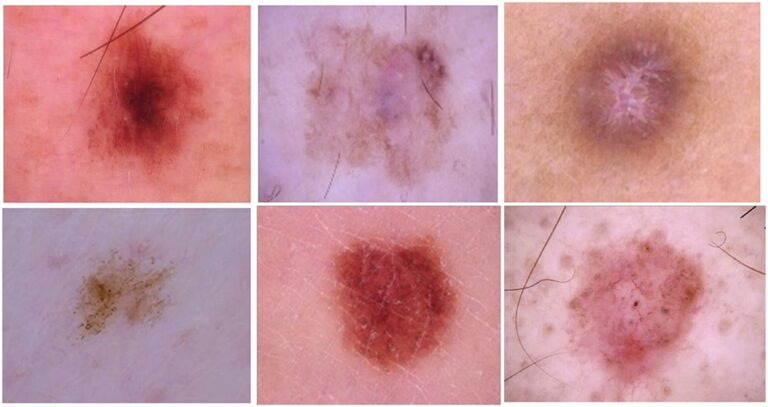 New method enables more reliable skin cancer detection by automatically predicting skin lesion types with greater accuracy